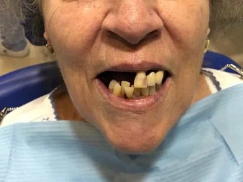 Situación inicial del caso: Rehabilitación con implantes y sobredentadura, con locators