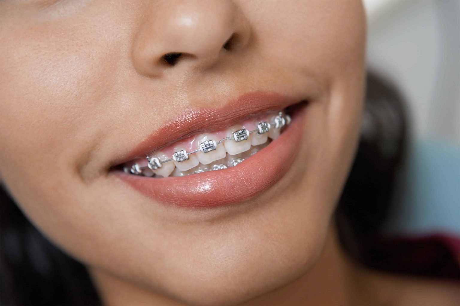 Primer plano de una sonrisa con brackets metálicos